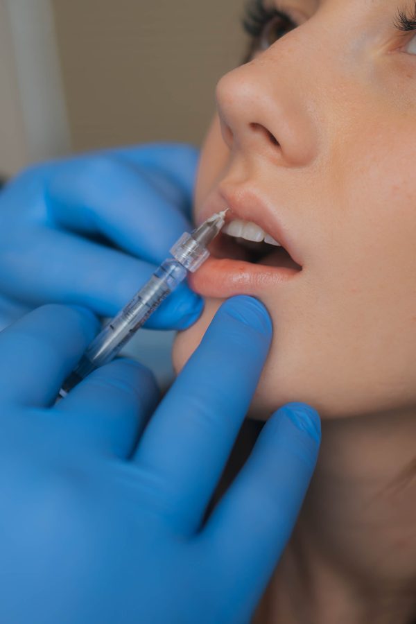 Versa filler- 1 syringe