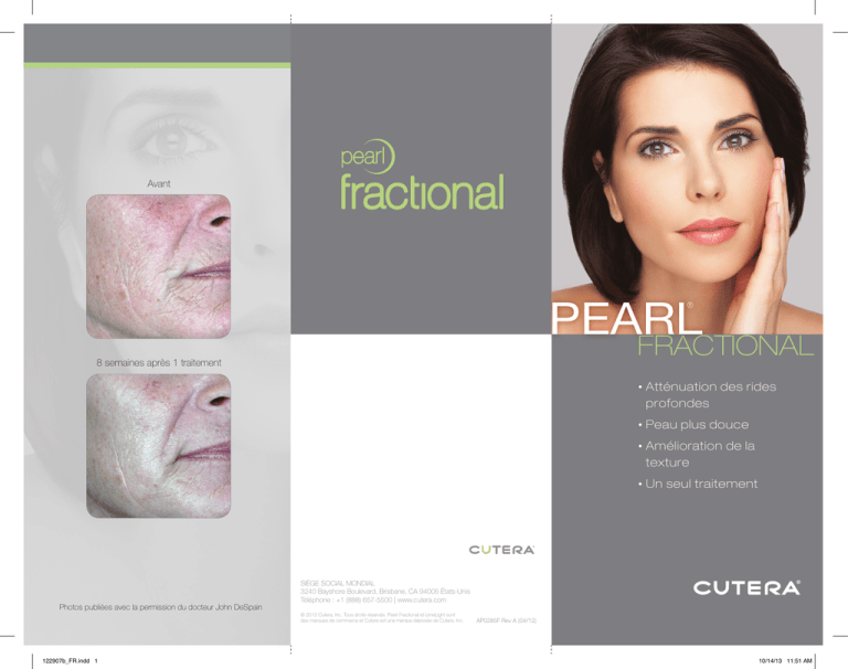 Cutera Pearl Ablative Laser Treatment - Face