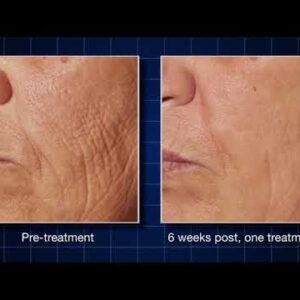 Cutera Pearl Ablative Laser - Add On Neck or Decollete