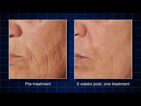 Cutera Pearl Ablative Laser - Add On Neck or Decollete